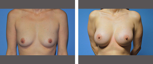 Breast augmentation cost dallas tx