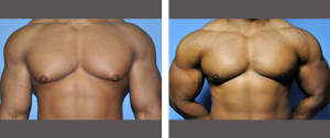 Excercise for male breasts Are not excercise for male breasts final