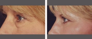 Blepharoplasty (Eyelid Surgery) Before and After Pictures Plano, TX