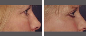 Blepharoplasty (Eyelid Surgery) Before and After Pictures Plano, TX
