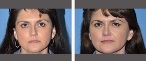 Rhinoplasty Before and After Pictures Plano, TX