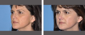 Rhinoplasty Before and After Pictures Plano, TX