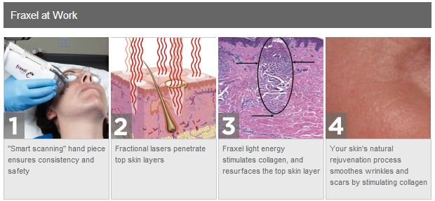 Fraxel® in Plano, TX