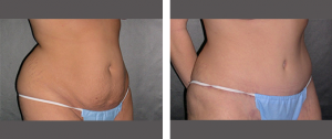 Abdominoplastia Fotos Antes e Depois de Plano, TX