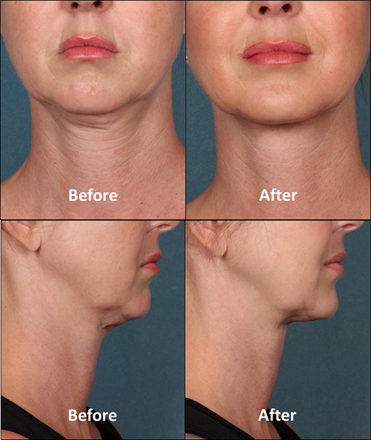 Kybella Before & After Group