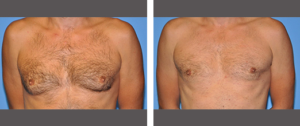 Gynecomastia Before and After Pictures Plano, TX