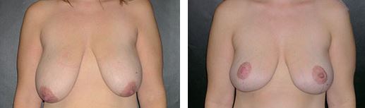 Breast Lift Before and After Pictures Plano, TX