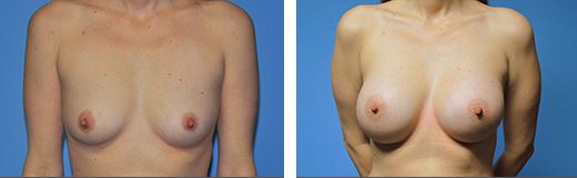 Breast Augmentation Before and After Pictures Plano, TX