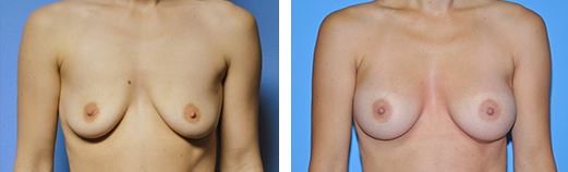 Breast Augmentation Before and After Pictures Plano, TX