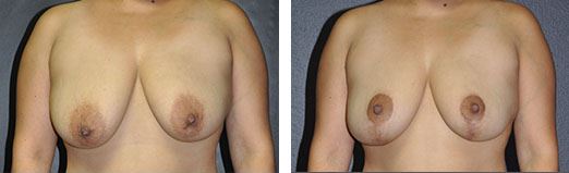 Breast Lift Before and After Pictures Plano, TX