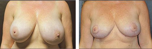 Breast Reduction Before and After Pictures Plano, TX