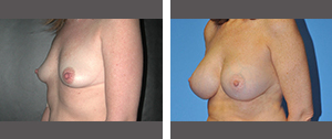 Breast Implants Before and After Pictures Plano, TX 