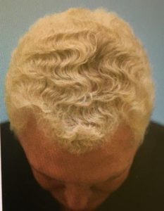 Hair Loss (PRP) Before and After Pictures Plano, TX