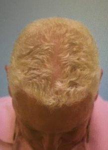 Hair Loss (PRP) Before and After Pictures Plano, TX