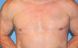 Gynecomastia Before and After Pictures Plano, TX