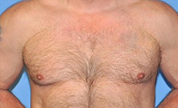 Gynecomastia Before and After Pictures Plano, TX