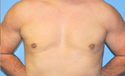 Gynecomastia Before and After Pictures Plano, TX