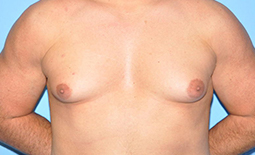 Gynecomastia Before and After Pictures Plano, TX