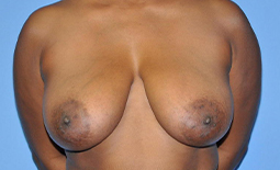 Breast Lift Before and After Pictures Plano, TX