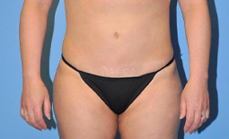 Liposuction Before and After Pictures Plano, TX