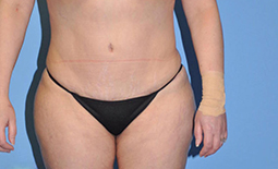 Liposuction Before and After Pictures Plano, TX