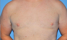 Gynecomastia Before and After Pictures Plano, TX