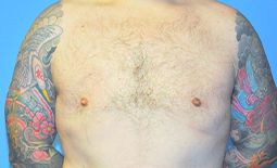 Gynecomastia Before and After Pictures Plano, TX