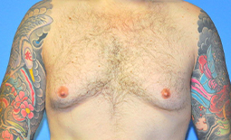 Gynecomastia Before and After Pictures Plano, TX