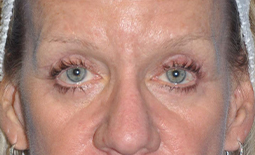 Blepharoplasty Before and After Pictures Plano, TX