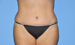 Tummy Tuck Before and After Pictures Plano, TX