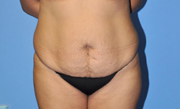 Tummy Tuck Before and After Pictures Plano, TX