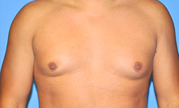 Gynecomastia Before and After Pictures Plano, TX