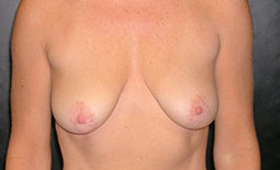 Breast Lift Before and After Pictures Plano, TX