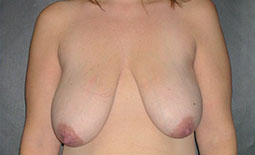 Breast Lift Before and After Pictures Plano, TX