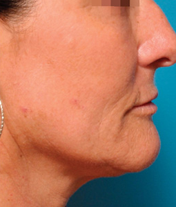 Halo™ Laser Treatment Before and After Pictures Plano, TX