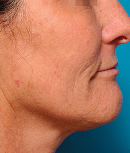Halo™ Laser Treatment Before and After Pictures Plano, TX