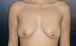 Breast Lift Before and After Pictures Plano, TX