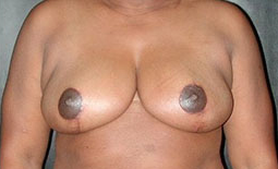Breast Reduction Before and After Pictures Plano, TX
