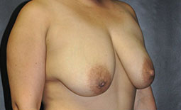 Breast Lift Before and After Pictures Plano, TX