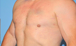 Gynecomastia Before and After Pictures Plano, TX