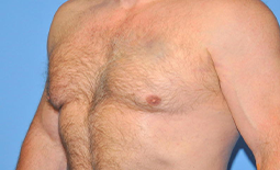 Gynecomastia Before and After Pictures Plano, TX