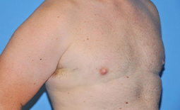 Gynecomastia Before and After Pictures Plano, TX