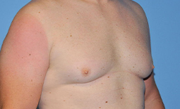 Gynecomastia Before and After Pictures Plano, TX