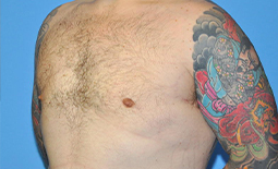 Gynecomastia Before and After Pictures Plano, TX