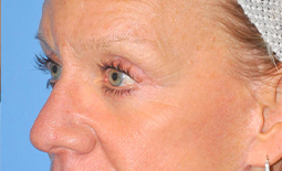 Blepharoplasty Before and After Pictures Plano, TX