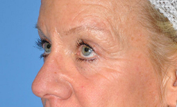 Blepharoplasty Before and After Pictures Plano, TX