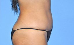 Tummy Tuck Before and After Pictures Plano, TX