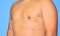 Gynecomastia Before and After Pictures Plano, TX