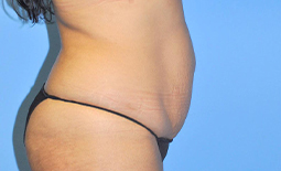 Liposuction Before and After Pictures Plano, TX