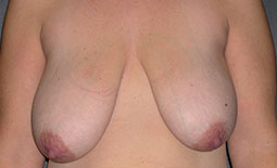 Breast Lift Before and After Pictures Plano, TX